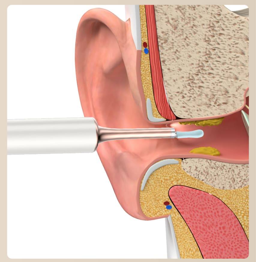 removedor de cerumen limpiando el oído